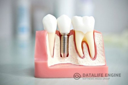 Импланты на зубы